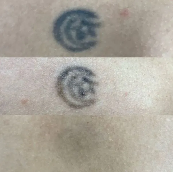 Antes e depois — remoção de tatuagem pequena