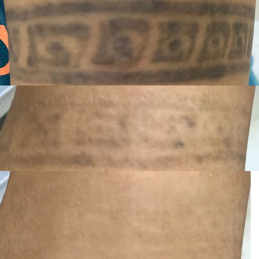 Antes e depois — clareamento progressivo de tatuagem